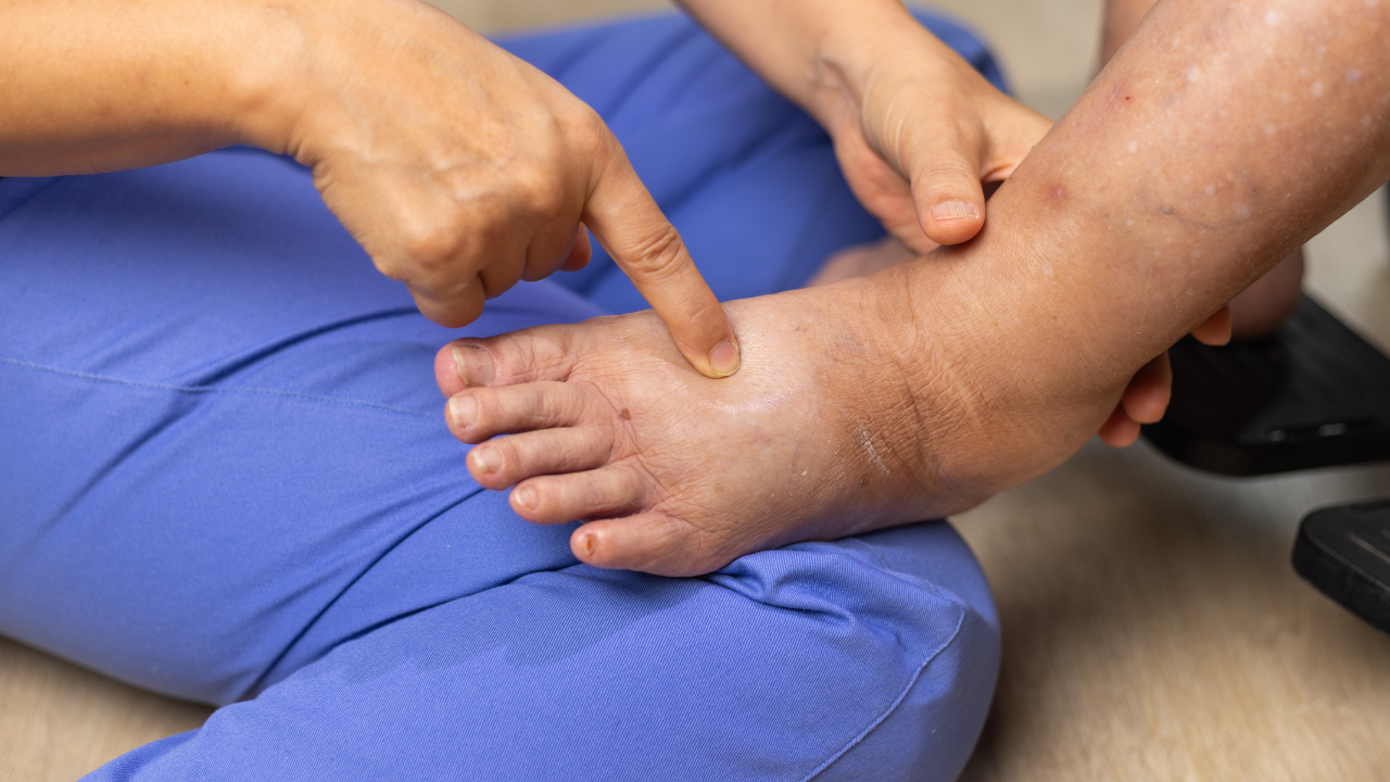 A caregiver examines swelling on an elderly person’s foot, showing signs of elderly skin care problems like dryness and irritation.